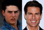 Tom cruise's teeth before and after photos and dental procedure