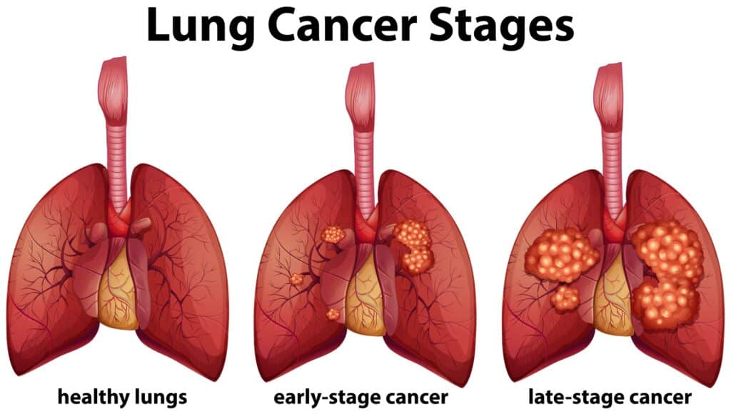 World Cancer Day 2023: Top 4 deadliest cancers in India and their symptoms as per oncologists.
